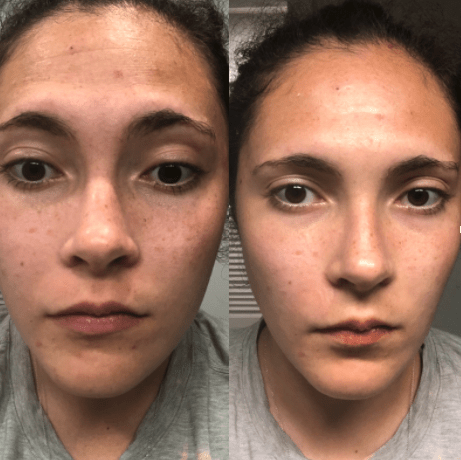 Photos of my face before (left) using microneedle patches and immediately after removing them (right).